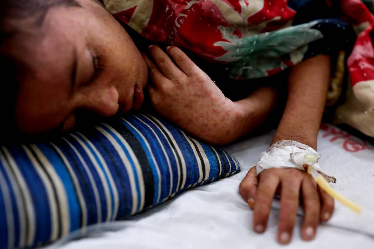 بحران سرخک در بنگلادش؛ مرگ بیش از هزار نفر در پی کاهش واکسیناسیون